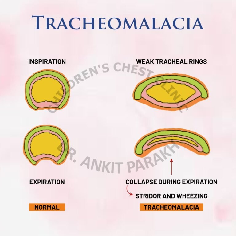 Tracheomalacia: An important cause of wheezing in young infants!