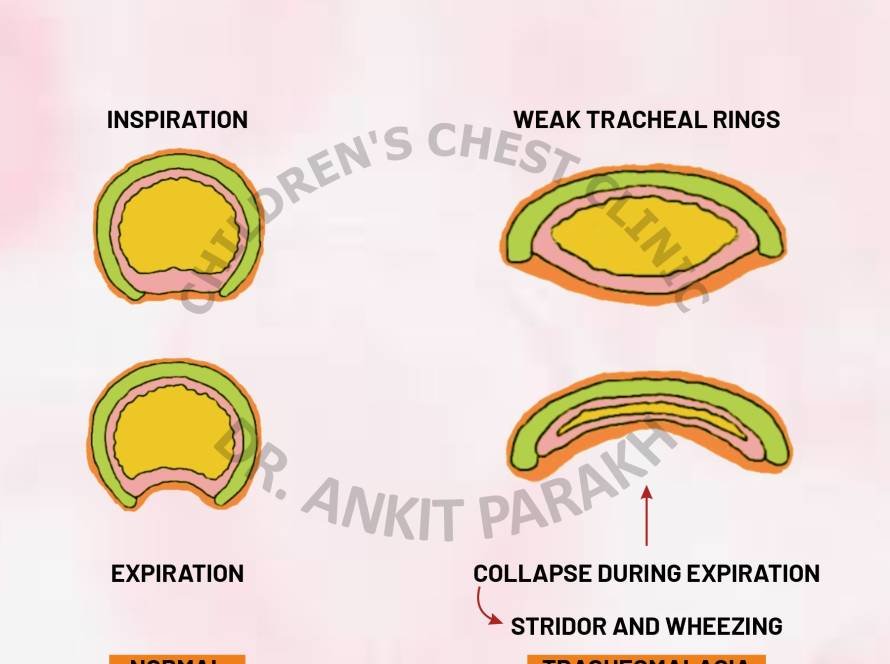 Tracheomalacia: An important cause of wheezing in young infants!