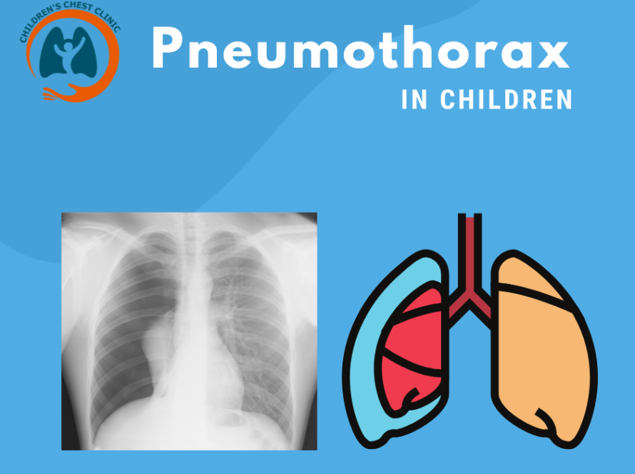 Pneumothorax in Children