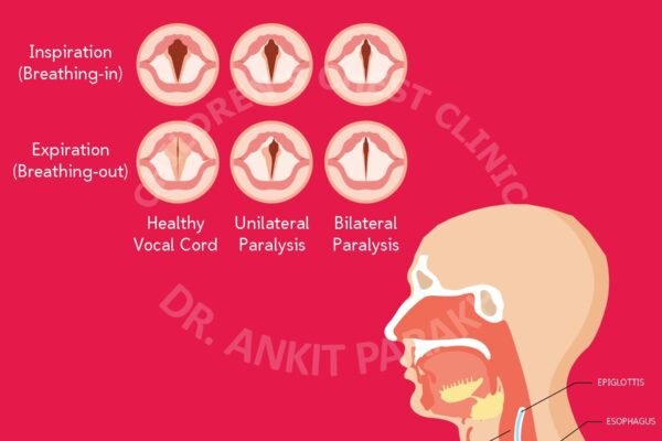 Vocal Cord Palsy in Neonates and babies: Causes, Diagnosis and Treatment!