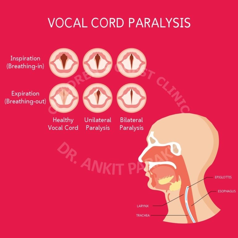 Vocal Cord Palsy in Neonates and babies: Causes, Diagnosis and Treatment!