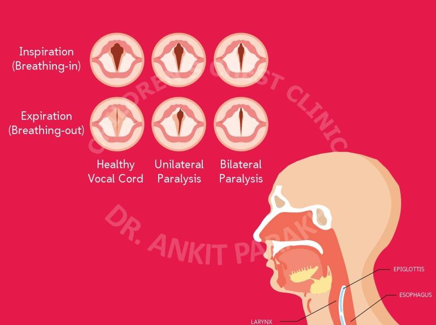 Vocal Cord Palsy in Neonates and babies: Causes, Diagnosis and Treatment!