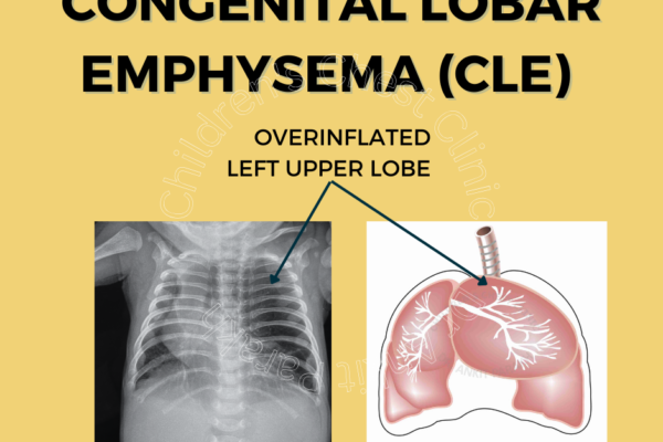 Congenital Lobar Emphysema