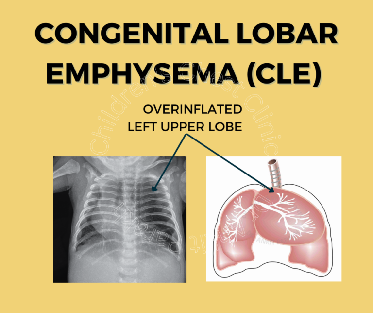 Congenital lobar emphysema: diagnosis and treatment