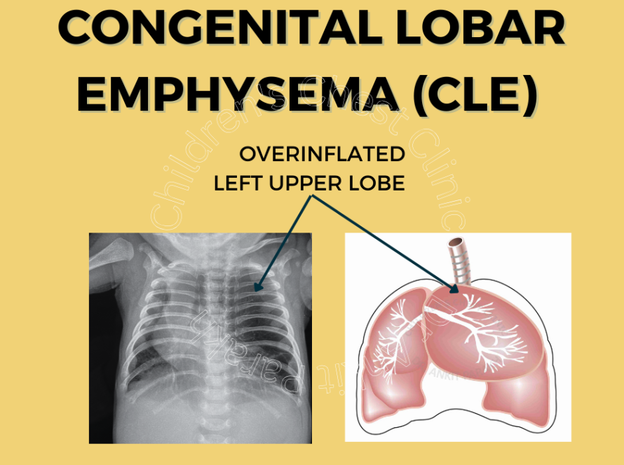 Congenital Lobar Emphysema