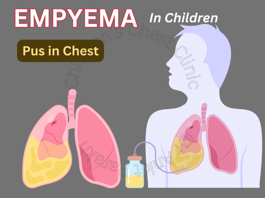 Empyema or Pus in the Pleural Space in Children!!