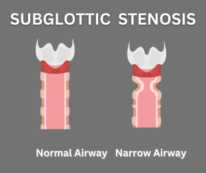 Subglottic Stenosis in Children!