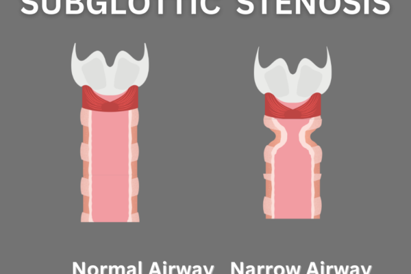 Subglottic Stenosis in Children!