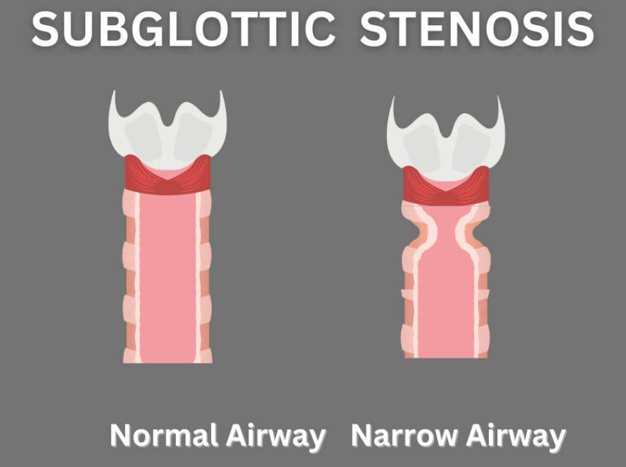 Subglottic Stenosis in Children!