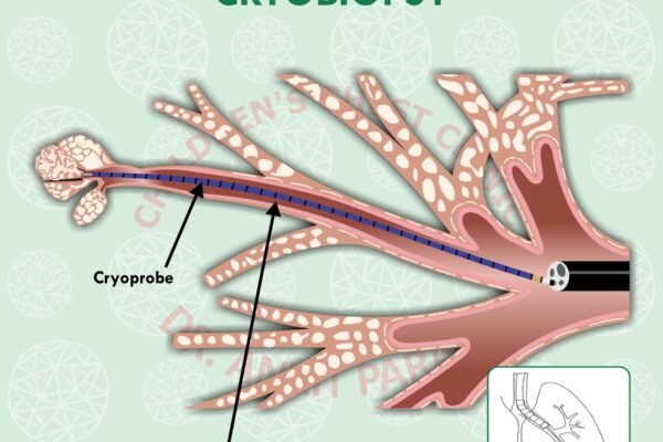 Lung Biopsy in Children: An important tool for diagnosis of complex lung problems!!