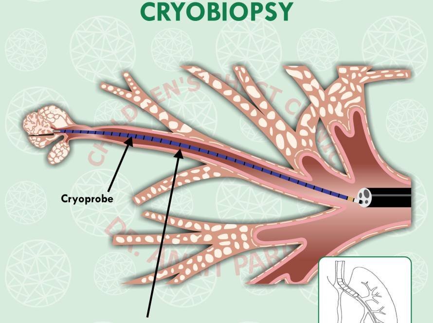 Lung Biopsy in Children: An important tool for diagnosis of complex lung problems!!