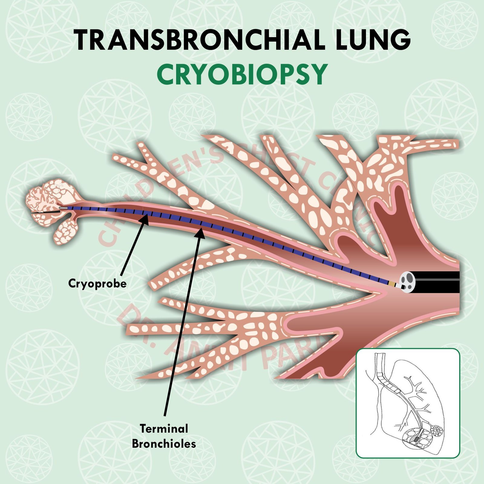 Lung Biopsy in Children: An important tool for diagnosis of complex lung problems!!