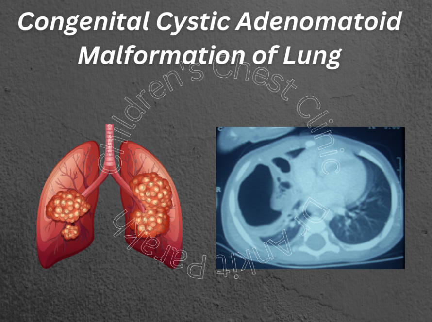 Congenital Cystic Adenomatoid malformation of Lung (CCAM)