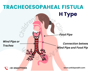 H-Type Tracheoesophageal Fistula in Children 