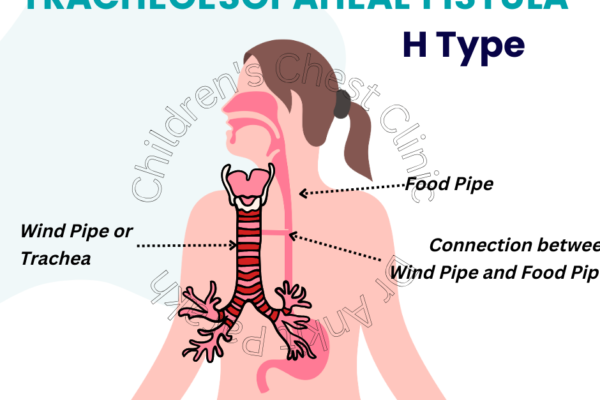 Understanding H-Type Tracheoesophageal Fistula in Children