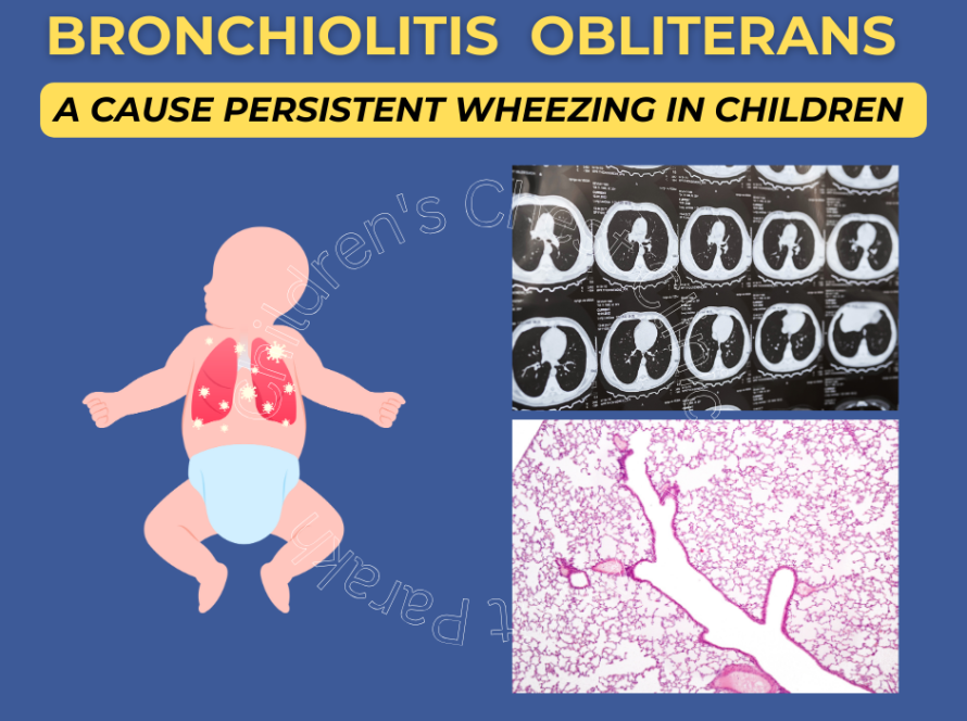 Bronchiolitis Obliterans