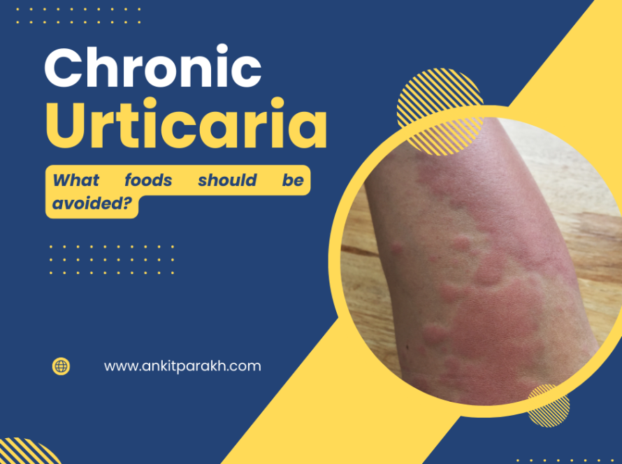 Chronic Urticaria