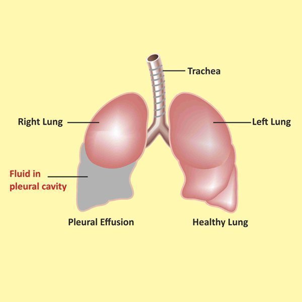 Pediatric Pleural Procedures