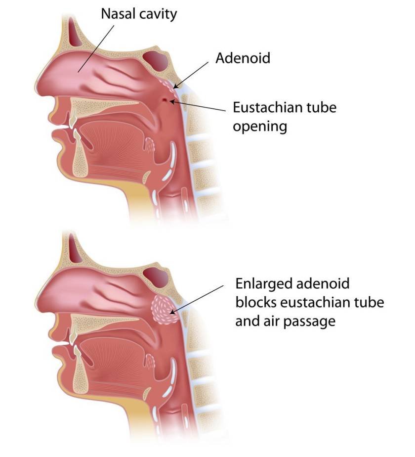 adenoid-hypertrophy-in-children-symptoms-diagnosis-treatment-by-dr