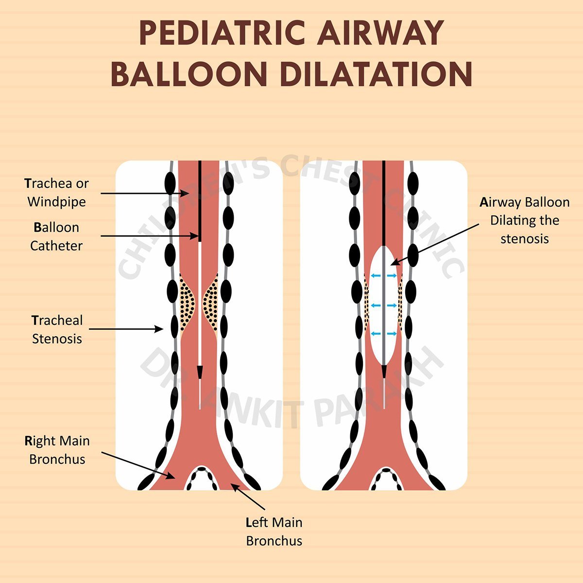 Pediatric Airway Balloon Dilatation