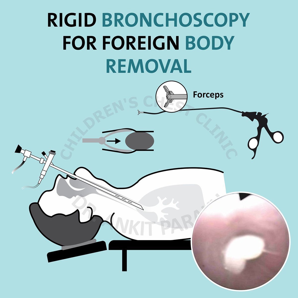 Rigid Bronchoscopy For Foreign Body Removal