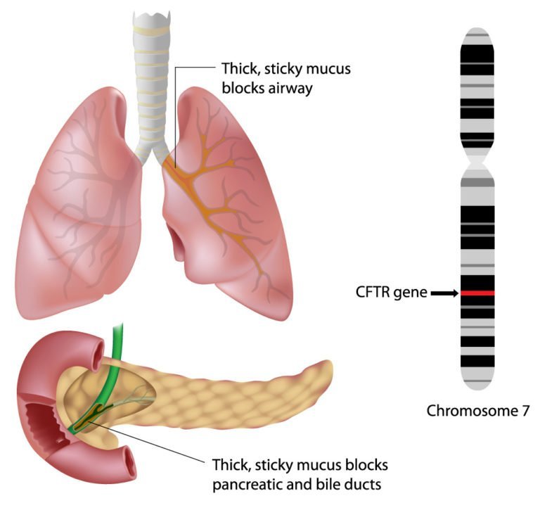 cystic fibrosis1