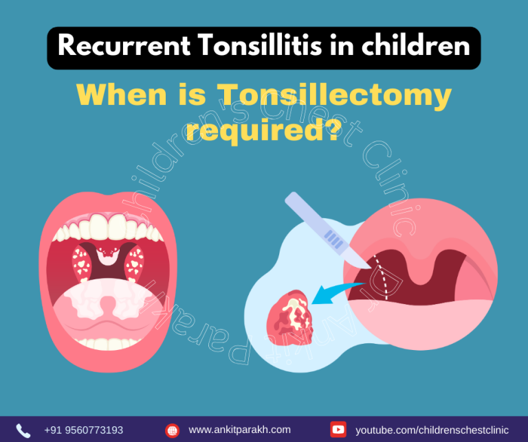 When is tonsillectomy required in children?