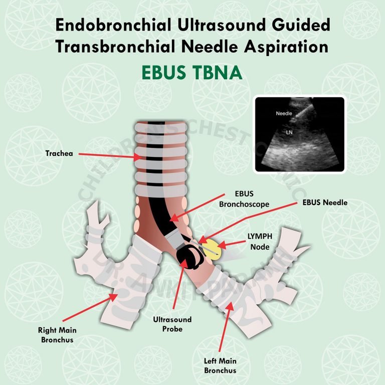 Endobronchial Ultrasound Guided Transbronchial Needle Aspiration