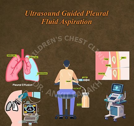 Ultrasound Guided Pleural Fluid Aspiration