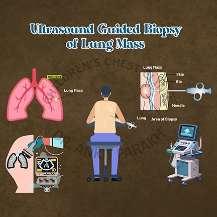 Ultrasound Guided Biopsy of Lung Mass