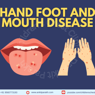 Hand Foot and Mouth Disease in Children