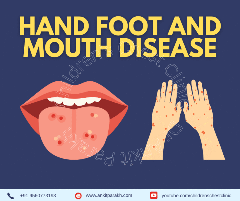 Hand Foot and Mouth Disease in Children