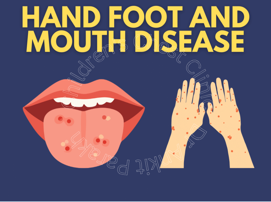 Hand Foot and Mouth Disease in Children