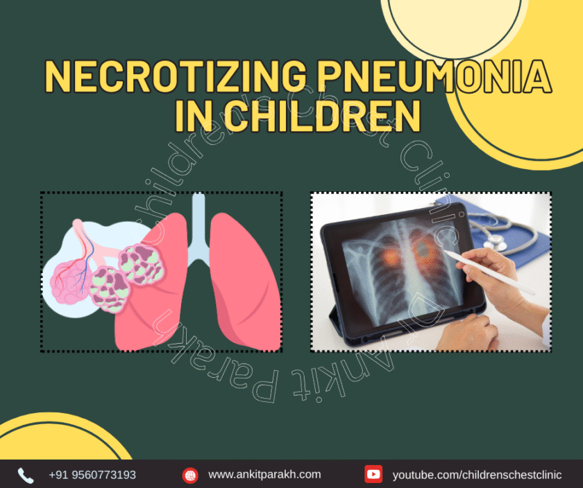 Necrotizing Pneumonia in Children