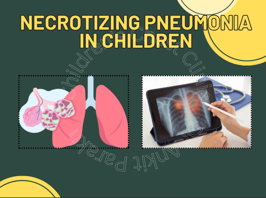 Necrotizing Pneumonia in Children