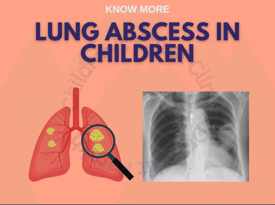Lung Abscess in Children