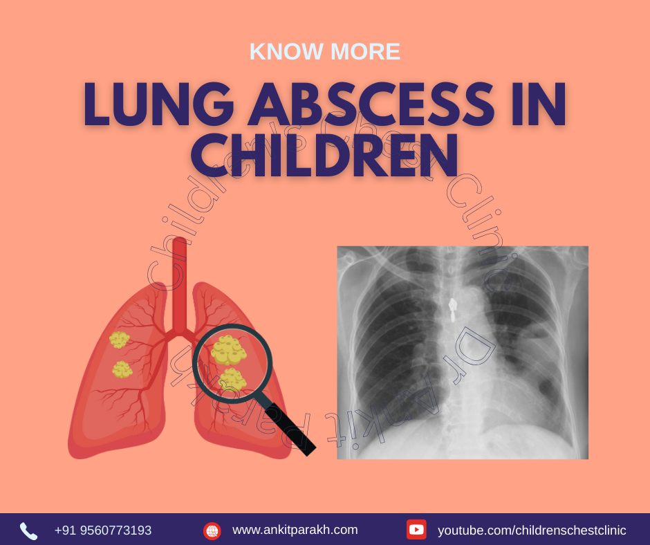 Lung Abscess in Children