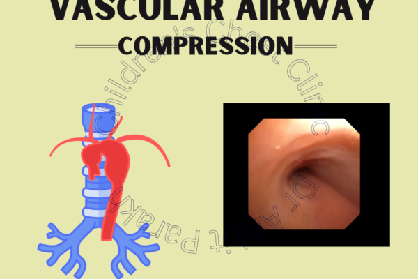 Vascular Airway Compression in Children