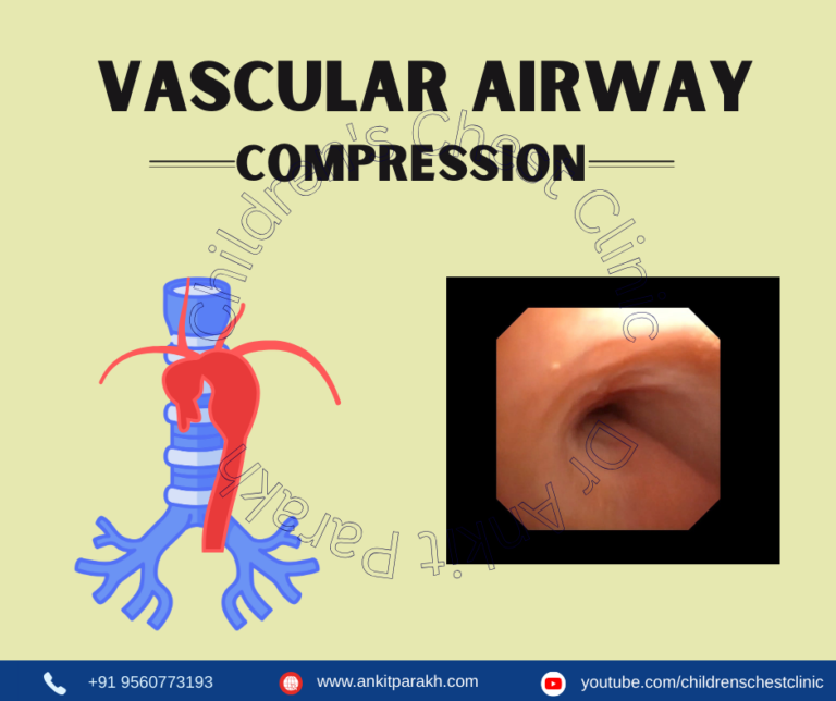 Vascular Airway Compression in Children – Symptoms, Diagnosis & Modern Management