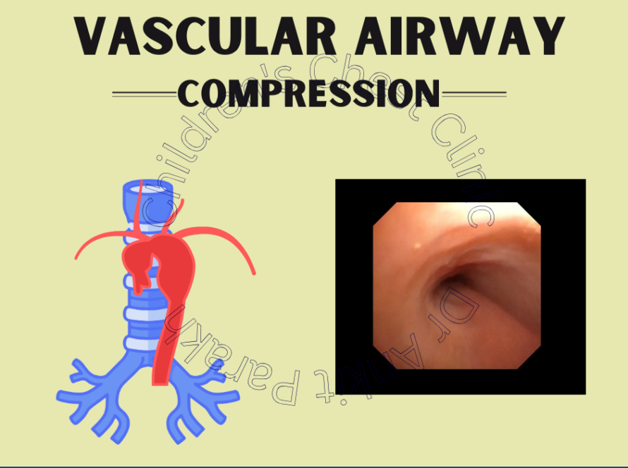 Vascular Airway Compression in Children
