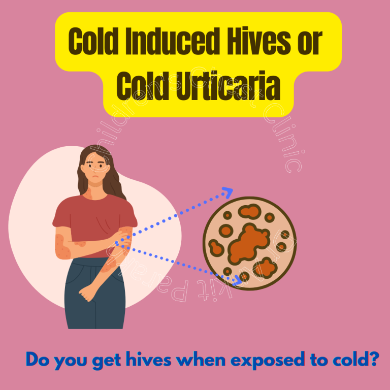 Cold Urticaria in Children: Symptoms, Causes, Diagnosis and Treatment
